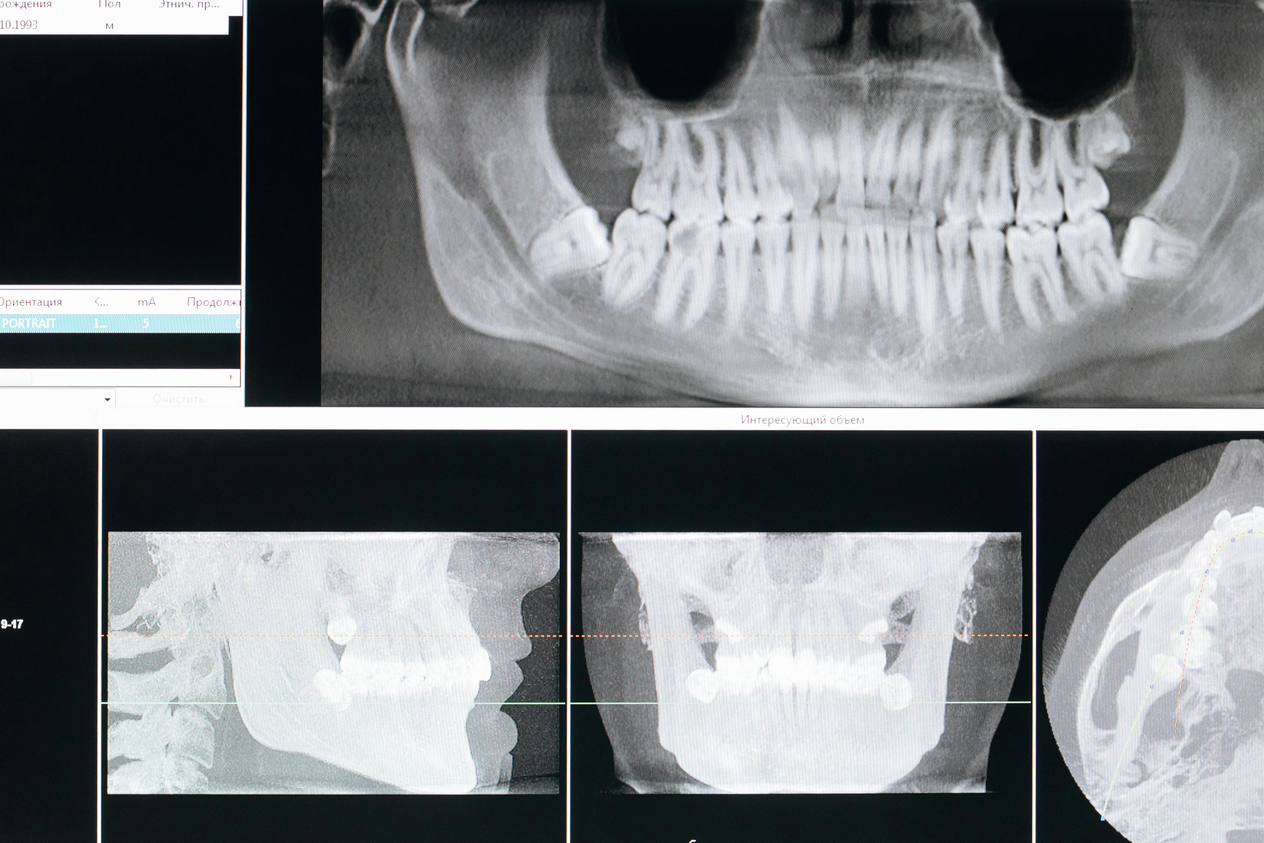 Digital X-ray